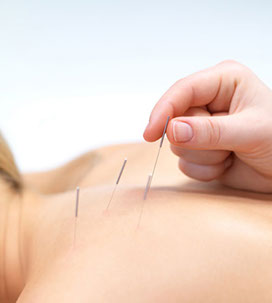acupuncture on back