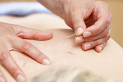 acupuncture needles going into somebody's back skin