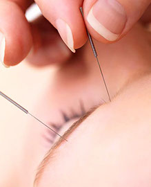 facial acupuncture needling